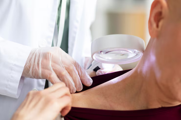 Skin Cancer Checks